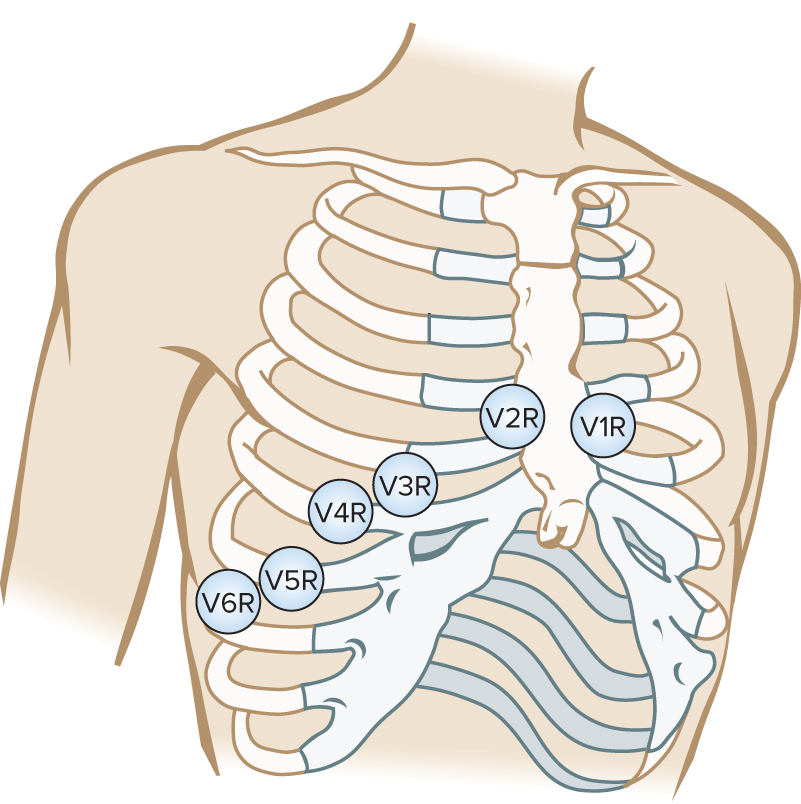 <p>Mirror image of a left sided 12 lead ECG</p>
