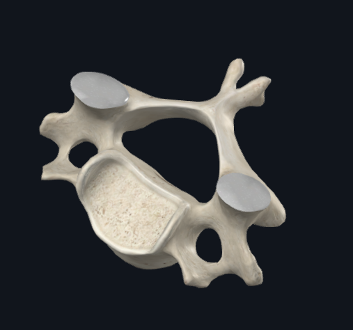 <p>Which region of the vertebra is this likely to be in</p>