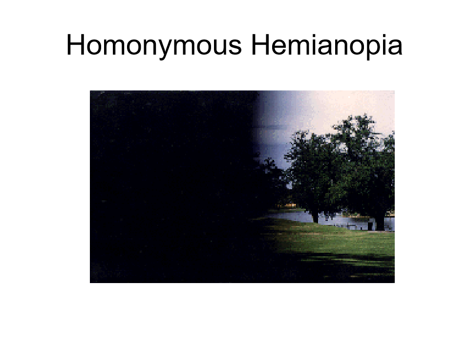 <p>Nothing wrong with the persons eyes but the brain doesn’t display half of the visual field. </p>