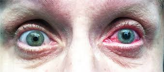 <p>pattern of redness: diffuse conjunctival injection</p><p>pain: severe<br>aching<br>deep<br>severe photophobia</p><p>vision: decreased</p><p>ocular discharge: absent</p><p>pupil: dilated<br>fixed</p><p>cornea: steamy<br>cloudy</p><p>significance/E: acute increase in intraocular pressure<br>emergency</p>
