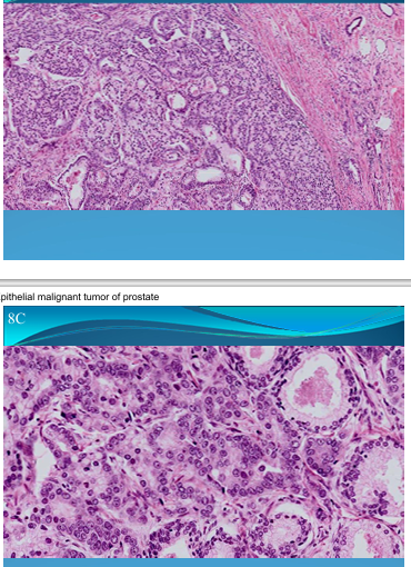 <p>PROSTATE:</p><p>Prostatic adenocarcinoma: Grade 3/4, epithelial malignant tumor</p>