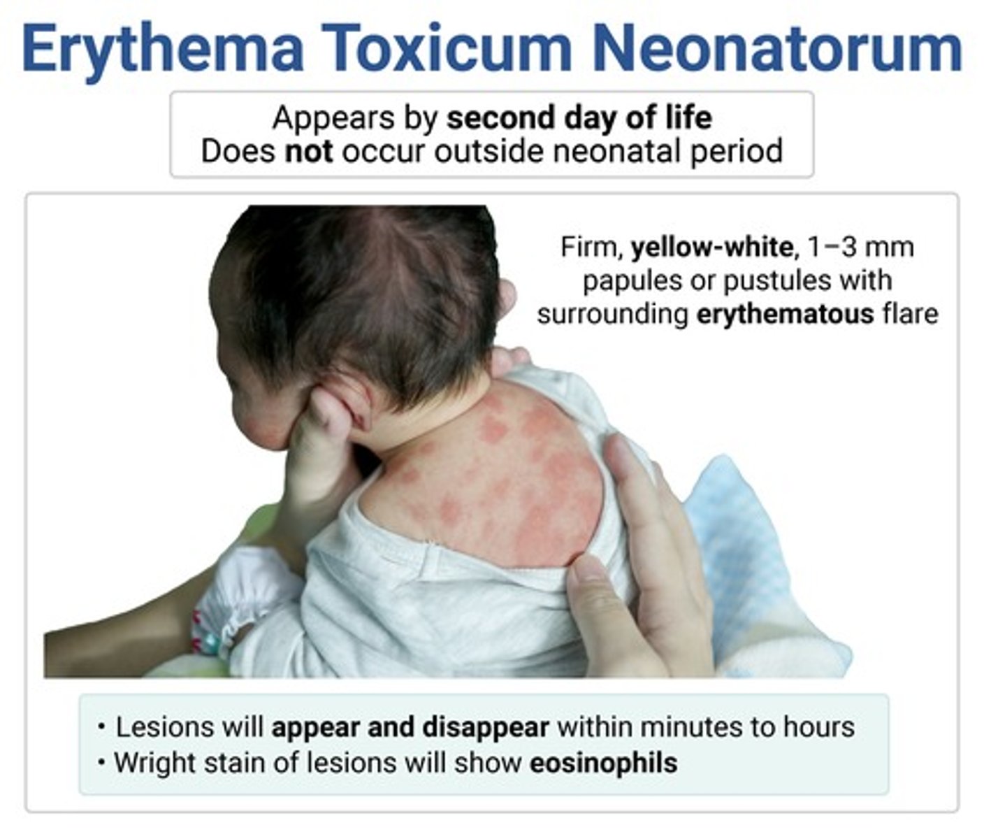 <p>erythema toxicum neonatorum → resolves spontaneously</p>
