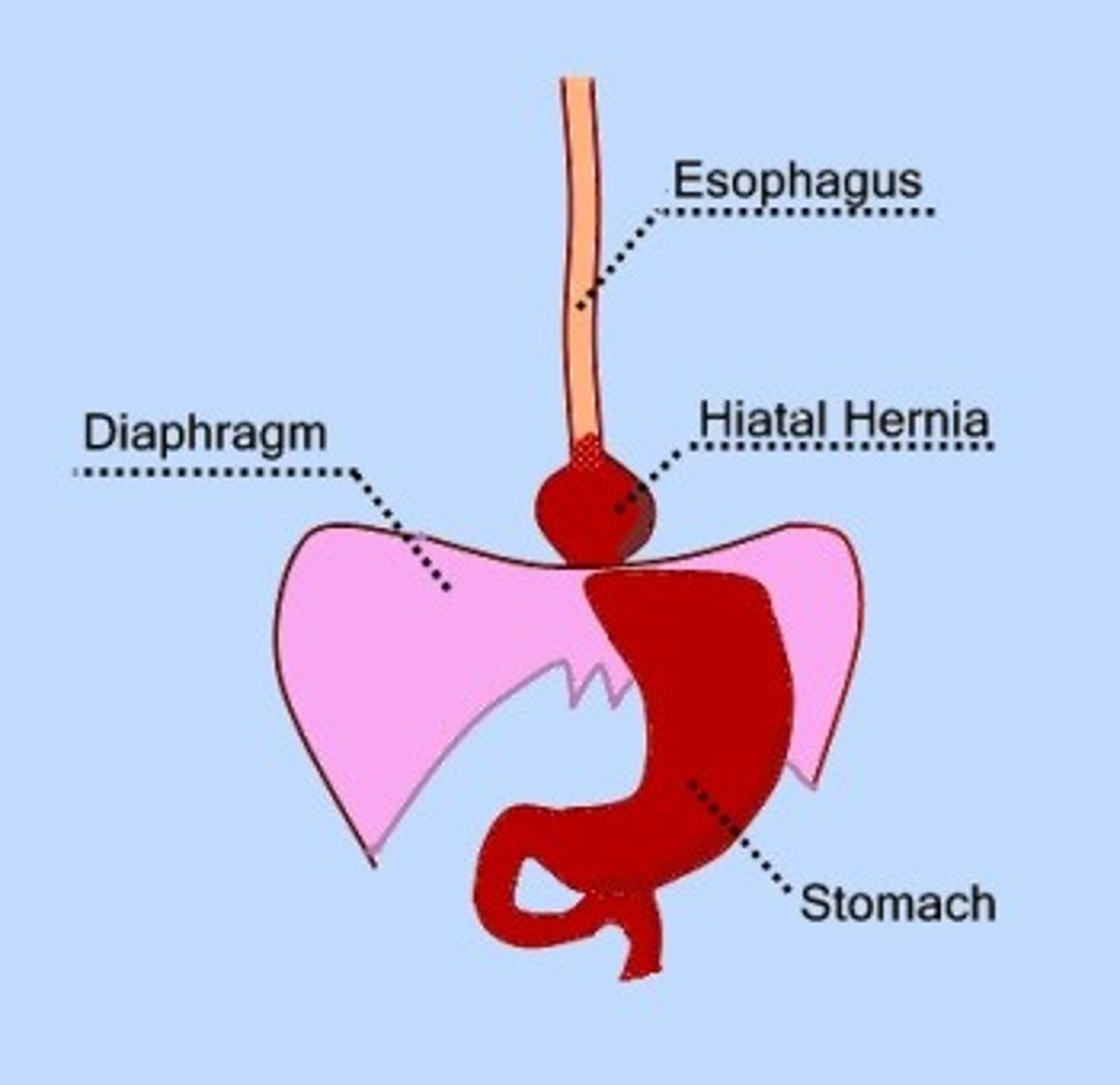 <p>Protrusion of a portion of the stomach upward through the diaphragm</p>