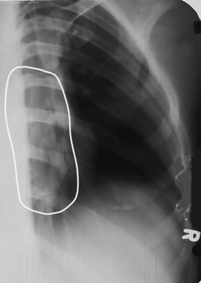 <p>Sternum still superimposes spine.</p>