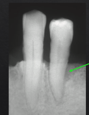 <ul><li><p>occlusal trauma jiggles the tooth + “pumps” the infection apically along the PDL → <u>vertical</u><strong> </strong>bone loss from <strong>occlusal trauma + inflammation</strong> and <u>horizonta</u>l bone loss from <strong>inflammation </strong></p></li><li><p>suggesting<strong> occlusal trauma </strong>as a <strong>co-destructive factor </strong>of bone loss </p></li></ul><p></p>