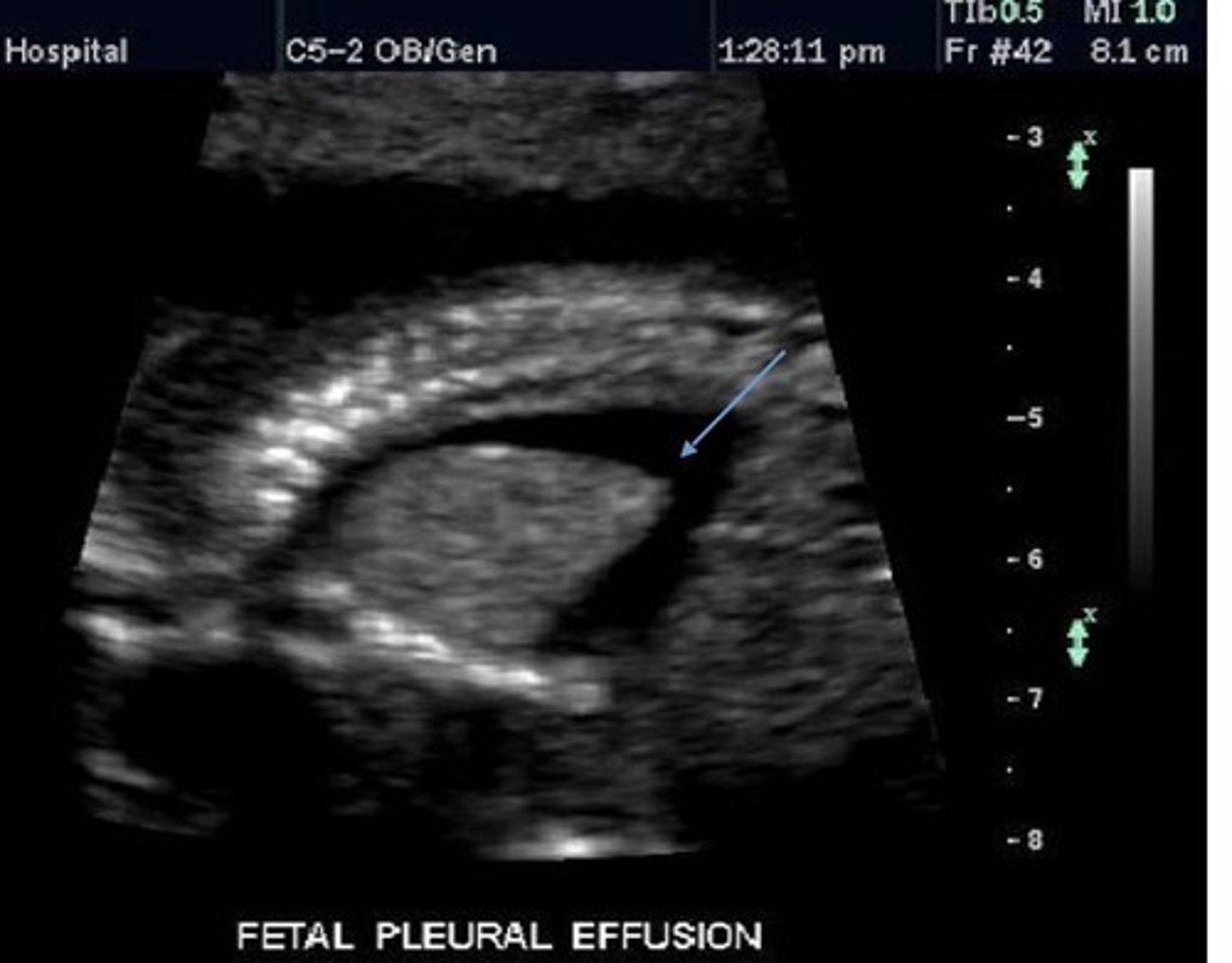 <p>Fluid in pleural cavity</p>