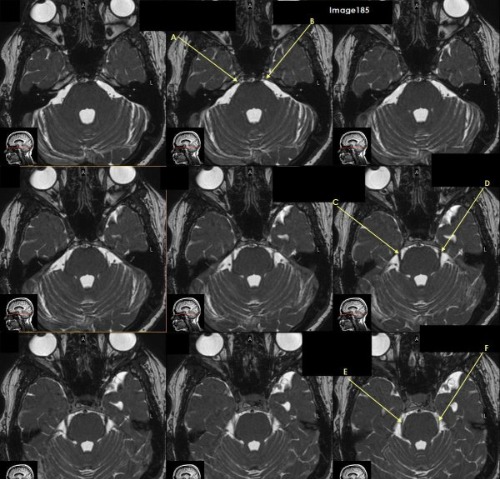 <p>letter C is pointing to which cranial nerve</p>