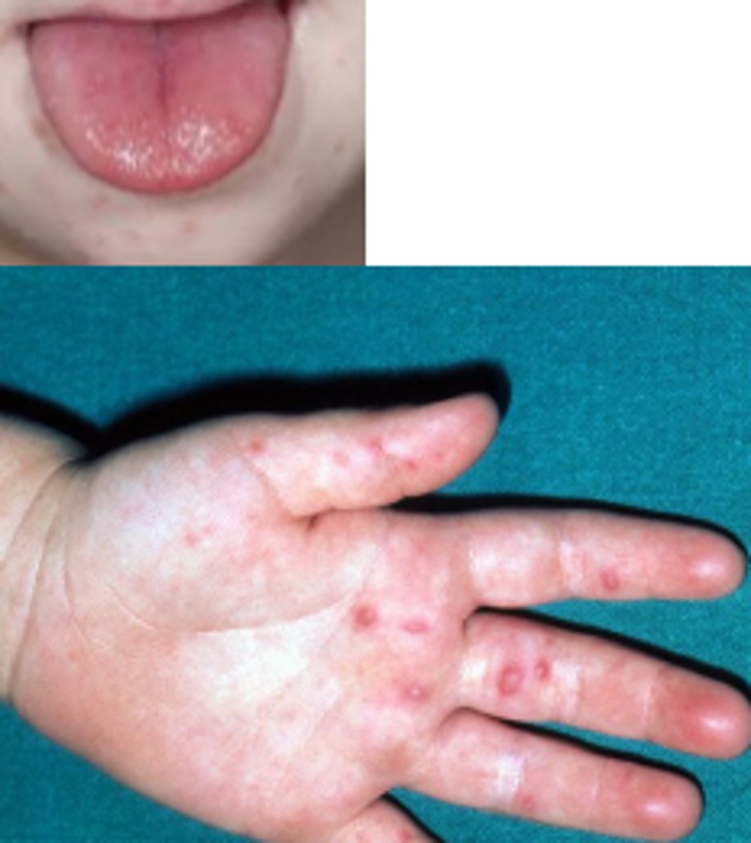 <p>maculopapular vesicular rash in</p><p>hands feet , oral ulcers</p><p>palmar plantar desquamation wks later</p><p>nail dystrophy 1-2m later</p>
