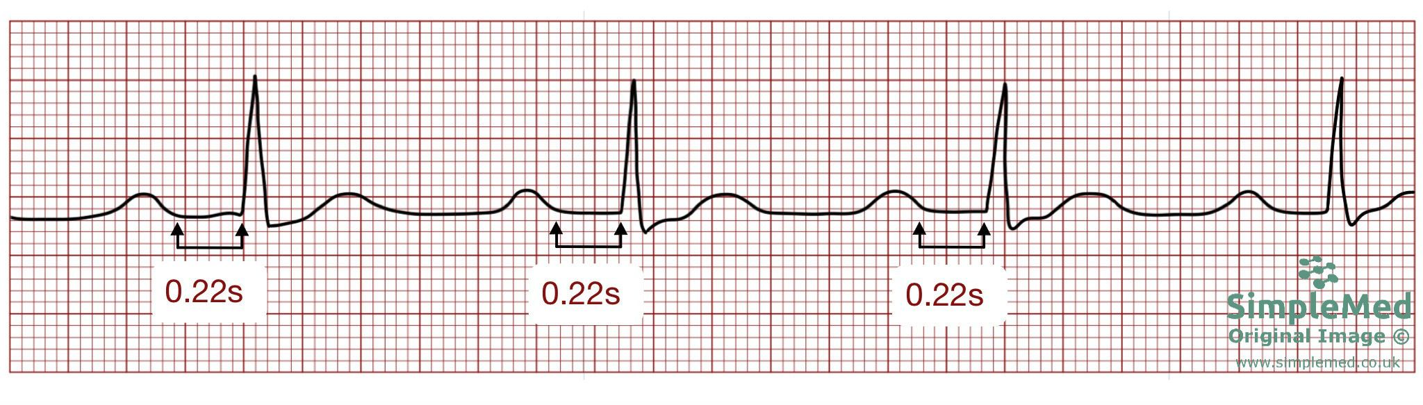 <p>name ECG pattern</p>