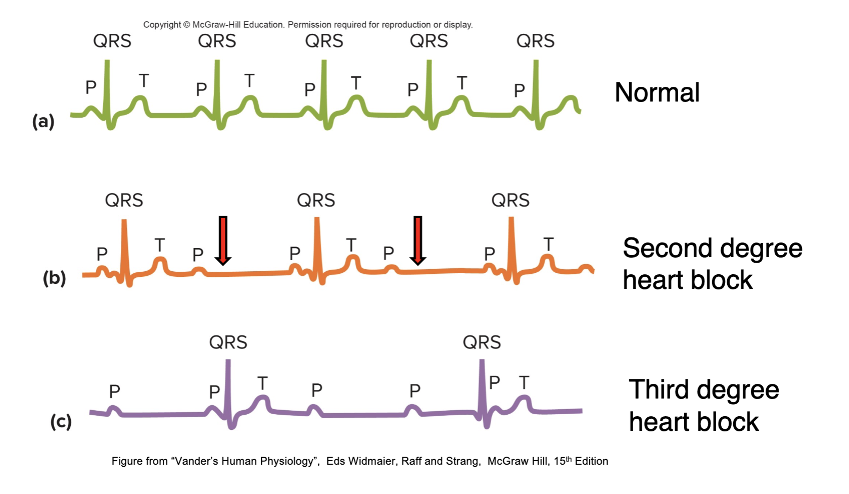 Fatigue, dizziness, shortness of breath, & chest pain.
