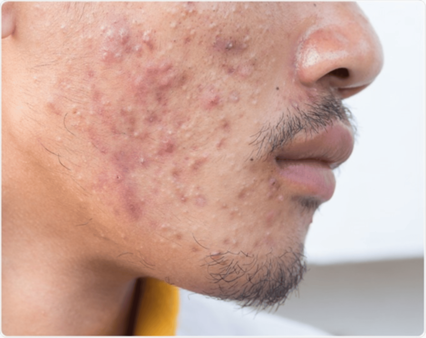 <p>A result of over-productive sebaceous glands, which leads to formation of blackheads and inflammation of the skin.</p>