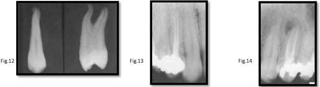 <p>canal anatomy of <strong>mx 1st premolar</strong></p>