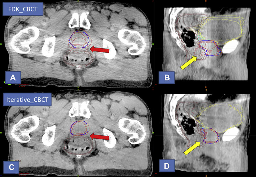 <p>prostate-rectal interface</p>