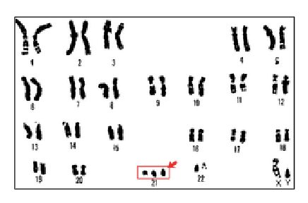 <ul><li><p>wide range of developmental delays and physical disabilities</p></li><li><p>approximately half the people with down syndrome will have a congenital heart defect</p></li><li><p>duplication of 500-800 genes</p></li><li><p>phenotype is varied mainly due to variable expression of a subset of those genes</p></li></ul><p></p>