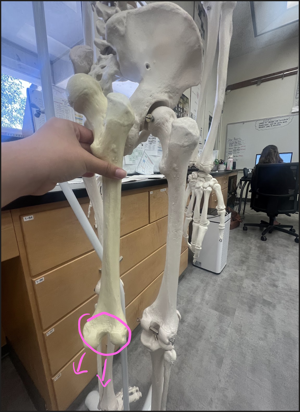 <p>Medial + Lateral condyles must always be..</p>