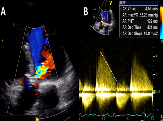 <p>very steep deceleration slopes </p>