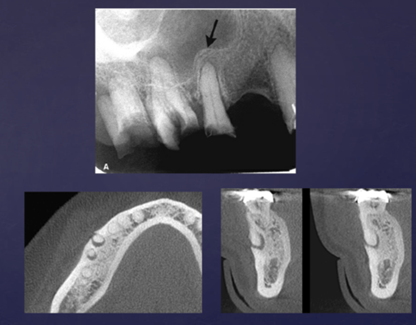 <p>T/F: Periapical inflammatory disease can cause periosteal new bone formation and perforation of bone border</p>