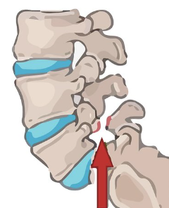 <p><strong><u>Degenerative</u></strong> process of the vertebral <strong><u>column</u></strong> &amp; a/w  soft tissue</p>