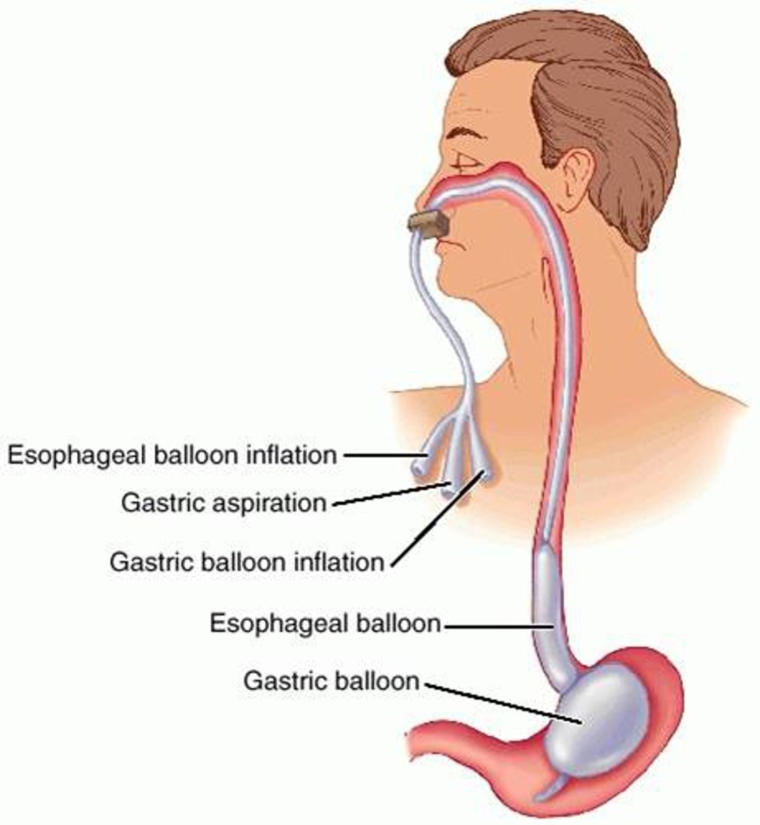 <p>- three-lumen tube used to hold pressure on the bleeding esophageal varices</p><p>- obstructs breathing so pt must be placed on mechanical ventilation</p>