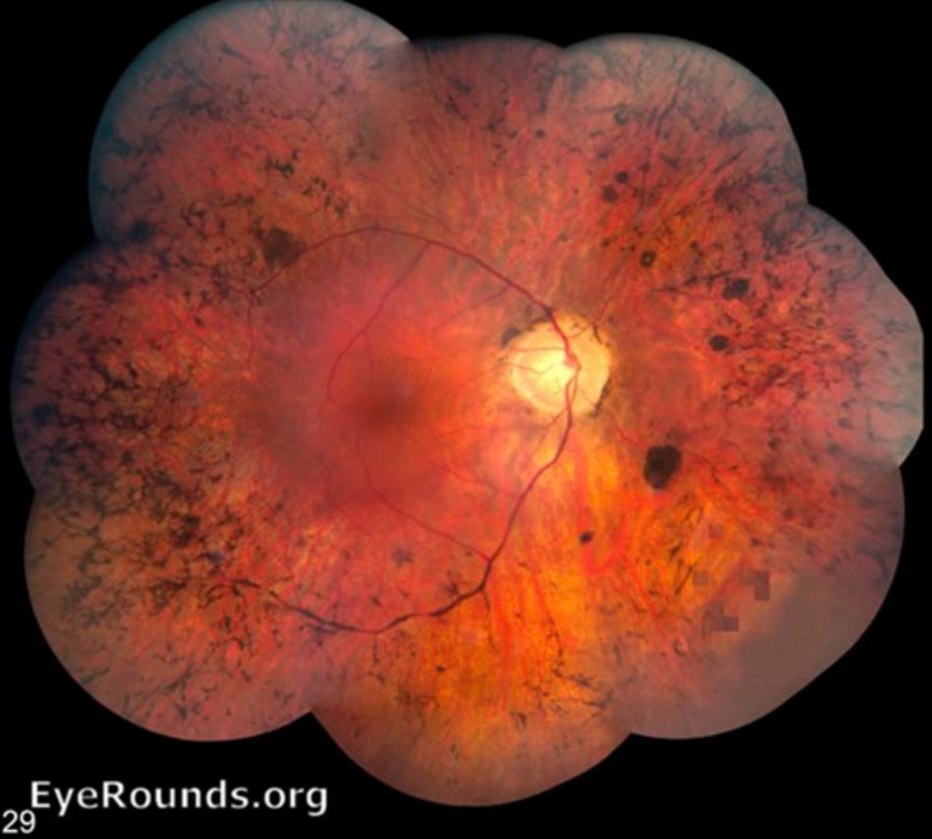 <p>What is <strong>retinitis pigmentosa (RP)</strong>?</p>