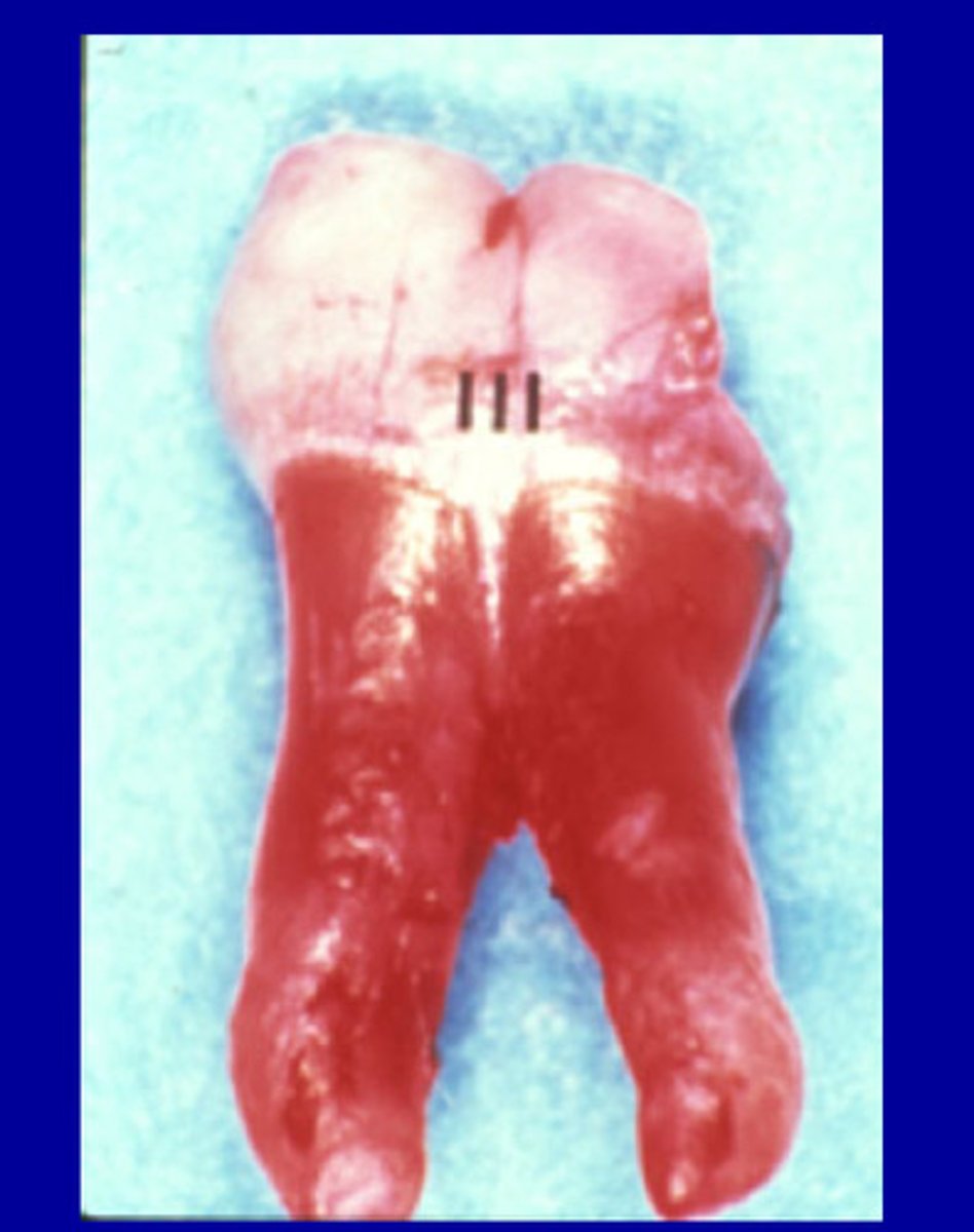 <p>Extension of enamel beyond the cervical margin</p>