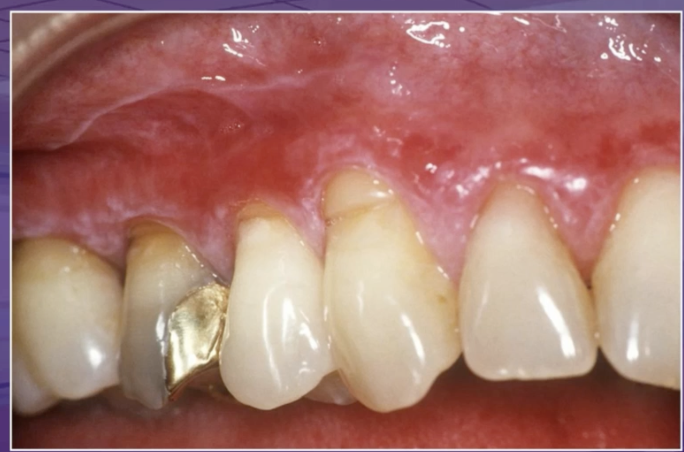 <p>which of the following agents does NOT cause lichenoid mucositis </p><p>toothpaste </p><p>medication </p><p>cinnamon </p><p>chewing tobacco </p>