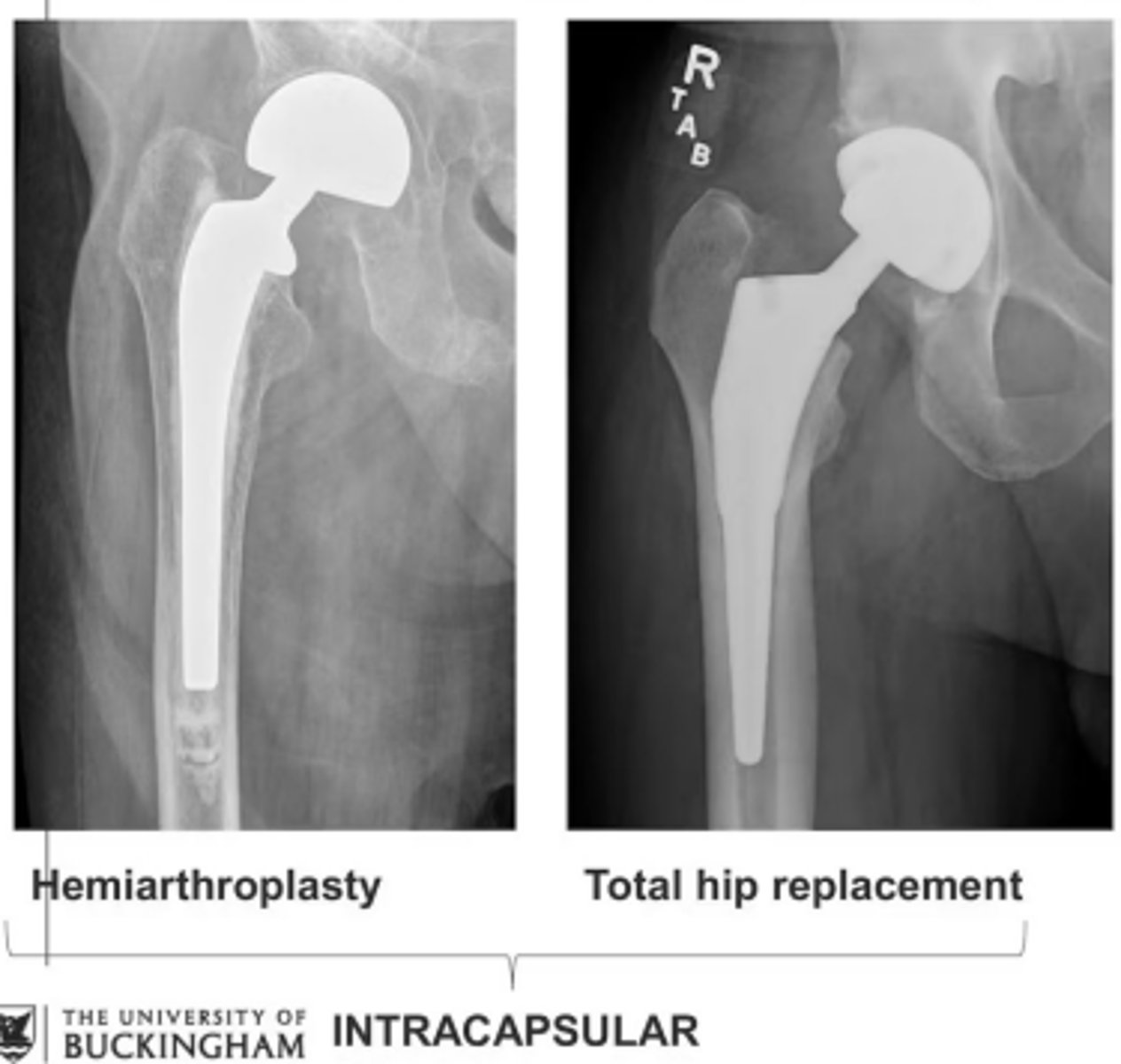 <p>Hemiarthroplasty</p><p>Total hip replacement</p>
