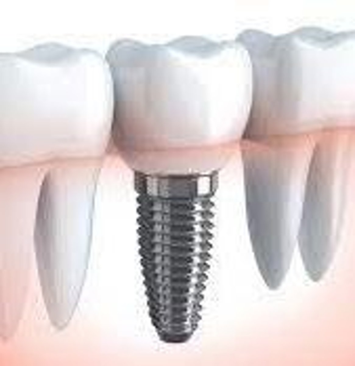 <p>BOP, suppuration, probing depth, radiographic bone loss, and implant mobility.</p>