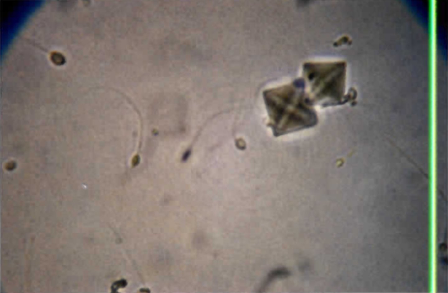 <p>What condition is suggested by the number of the formed element that predominates in the high-power field of Color Plate 51?</p><p>A. Glomerulonephritis</p><p>B. Improperly collected specimen</p><p>C. Pyelonephritis</p><p>D. Normal sample</p>