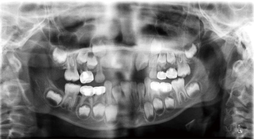 <p>The anterior teeth appear <strong>wider and blurry</strong>, and the condyles may appear near the edges.</p>