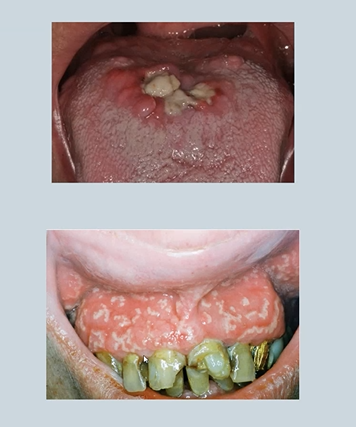 <ul><li><p>Inflammation in the <strong>colon - malabsorption </strong></p></li><li><p>Shallow non-granulomatous ulceration </p></li><li><p>Pyoderma gangrenosum - skin </p></li><li><p><strong>Pyostomatitis vegetans – oral - bottom</strong></p></li></ul><p></p>