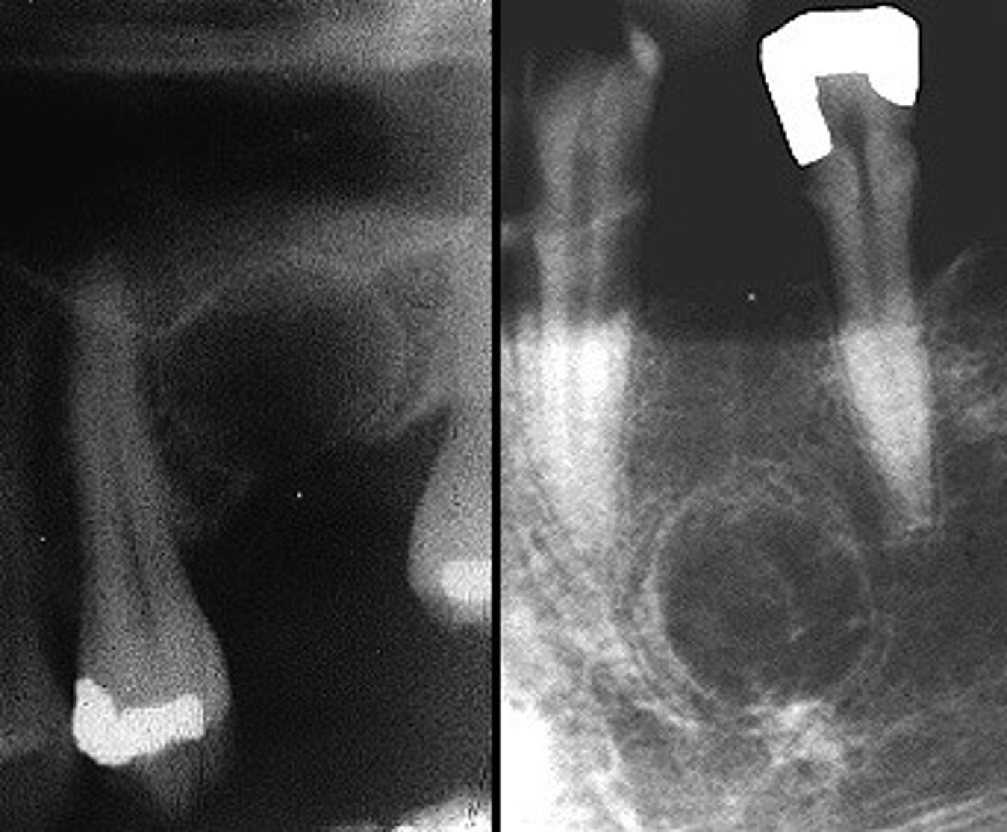 <p>peripapical inflammatory tissue that is not curetted at time of tooth removal</p>