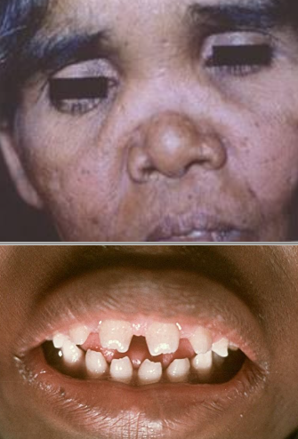 <p>What are the intraoral clinical manifestations of congenital syphillis?</p>