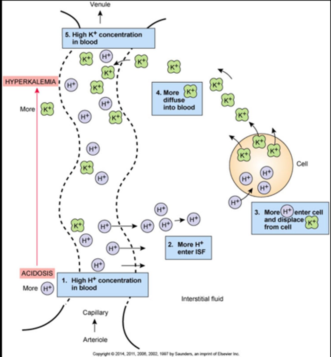 <p>Cardiovascular problems due to risk for hyperkalemia</p><p>(Too much H+ kicks K+ out of cells)</p>