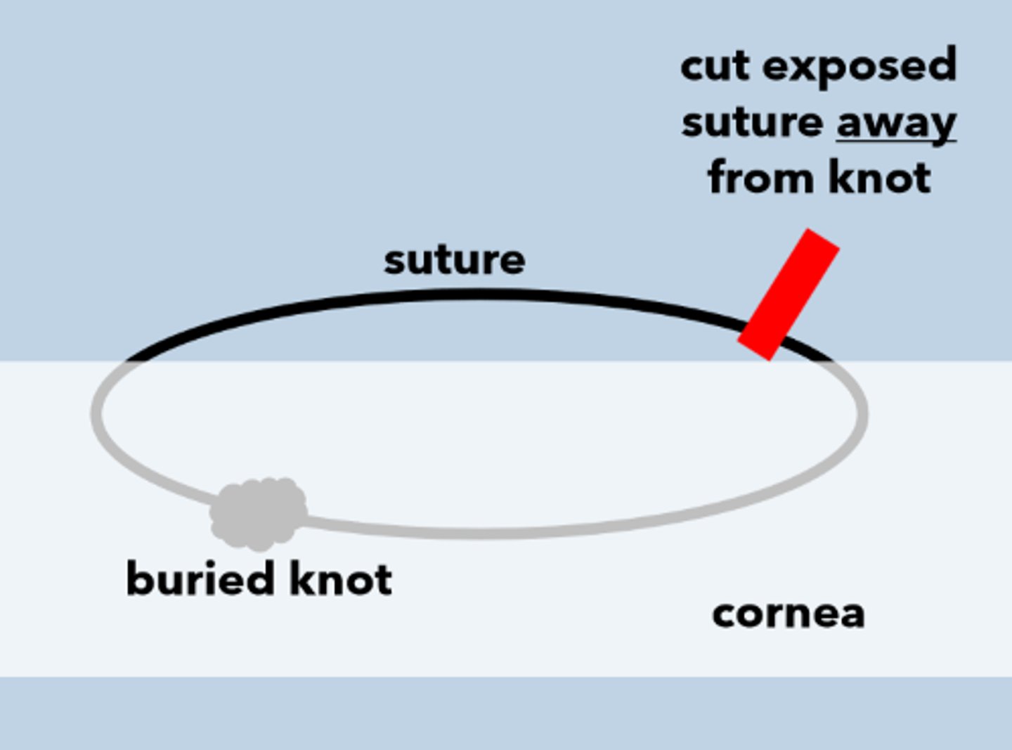 <p>When removing a suture after PKP, we want to limit which 2 things?</p>