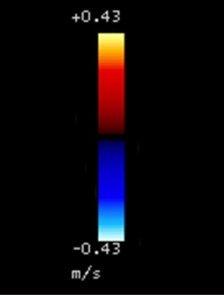 <p>According to the attached color map, what color will the blood be demonstrated that is moving away from the probe at 30cm/s and is highly turbulent?</p><p></p><p>a. blue<br>b. yellow<br>c. green<br>d. red</p>