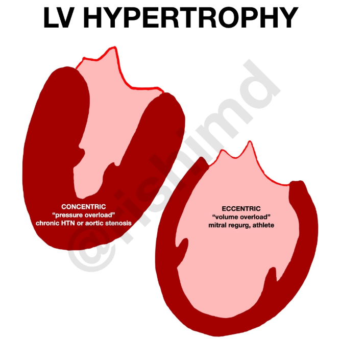 <p>Left ventricle: Chamber increases so it can hold more volume due to VOLUME OVERLOAD during exercise</p><p>Myocardium: Hypertrophies </p><p>Why? Likely volume overload due to an increase in blood plasma. Also, a lower resting heart rate will also likely contribute. Remember, CO is the SAME regardless of how fit you are if your at rest. So if HR is lower at rest and CO must be the same, SV must be higher all the time as well as during sub max exercise, resulting in this adaptation. </p>