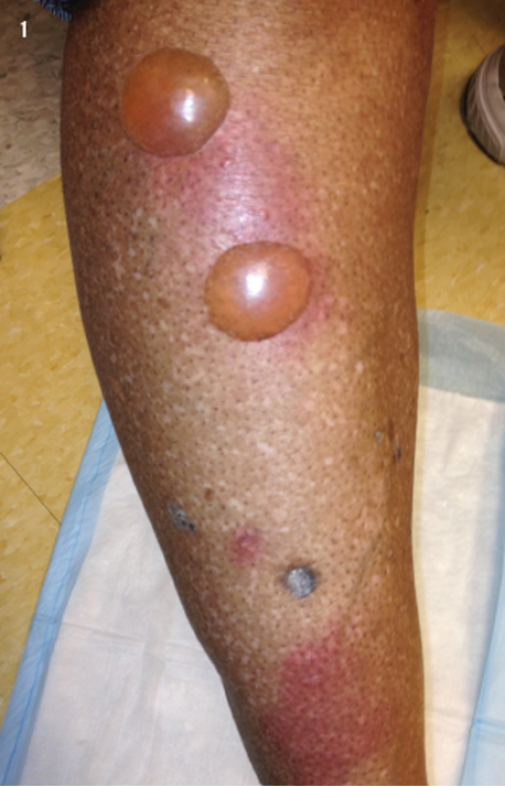 <p>Bullosis Diabeticorum </p>