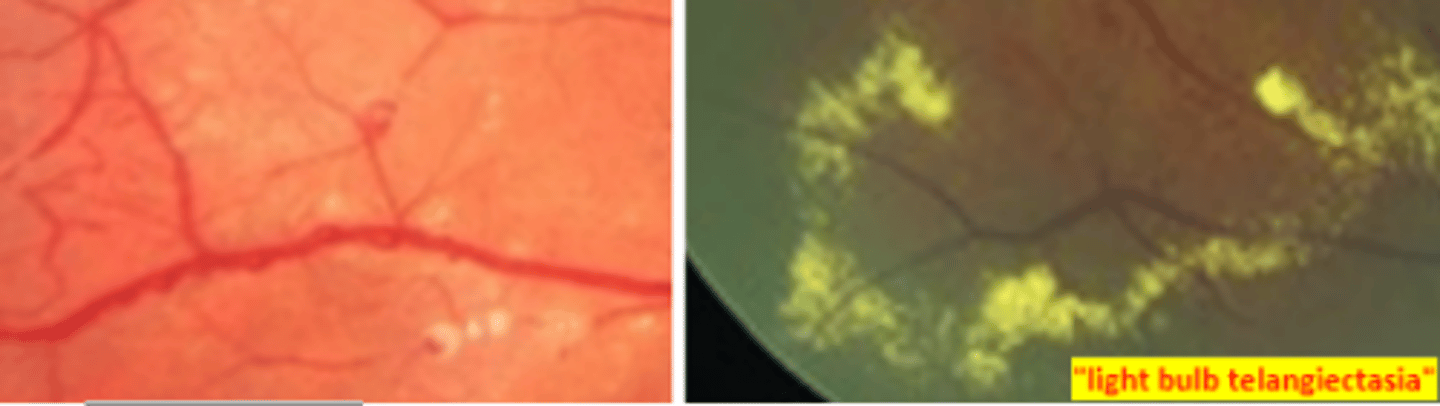 <p>a rare idiopathic unilateral retinal telangiectasia most commonly developing in young males (earlier presentation worse prognosis). Occurs with periods of exacerbations, but overall is progressive with each episode. Is a loss of blood retinal barrier that commonly results in exudation and subsequent retinal detachment. Neovascularization is also common. Patient presents with unilateral vision loss, strabismus, and leukocoria. Refer to retina for neovascularization, macular edema, retinal detachment, and neovascular glaucoma.</p>