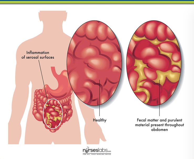 <p>Usually in surgeries, it is brought by bacterial infections during these procedures. </p>