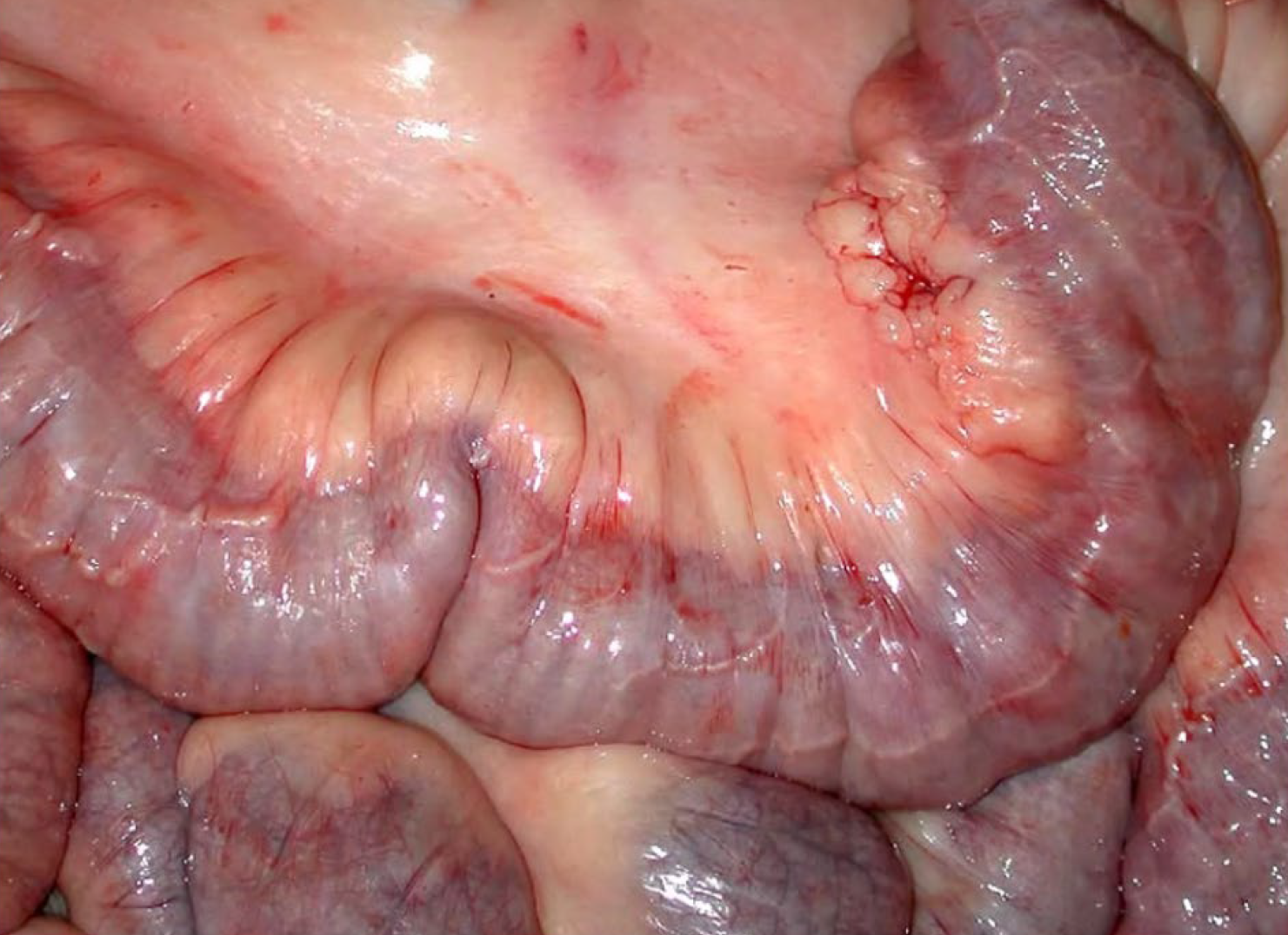 <p>What is a histologic feature?</p><p>A-Granulomatous lymphangitis</p><p>B-Peudomembranous enteritis</p><p>C-Suppurative leiomyositis</p><p>D-Suppurative peritonitis</p>