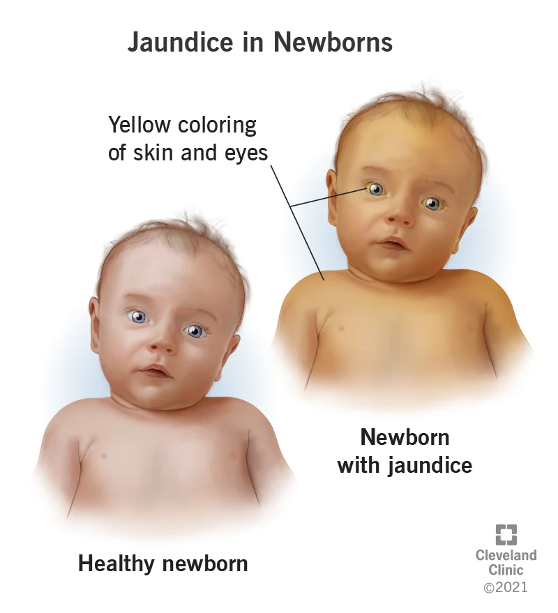 <ul><li><p class=""><span style="color: red">NEONATAL HYPERBILIRUBINEMIA</span></p></li><li><p class="">Seen in <strong>newborns</strong>, typically in the <strong>first week of life</strong></p></li><li><p class="">Caused by <strong>immature liver</strong> and <strong>deficiency of UDP-glucuronyl transferase (UDPGT)</strong></p></li><li><p class=""><strong>Unconjugated bilirubin</strong> builds up; <strong>premature infants</strong> at higher risk</p></li><li><p class="">Can progress to <strong>kernicterus</strong> (bilirubin deposition in brain) → <strong>brain damage/death</strong></p></li><li><p class=""><strong>Dangerous levels</strong>: can exceed <strong>20 mg/dL</strong></p></li><li><p class=""><strong>Treatment</strong>:<br>• <strong>Phototherapy</strong><br>• <strong>Exchange transfusion</strong><br>• <strong>Pharmacologic therapy</strong>, <strong>IVIG</strong>, <strong>metalloporphyrins</strong></p></li></ul><p></p>