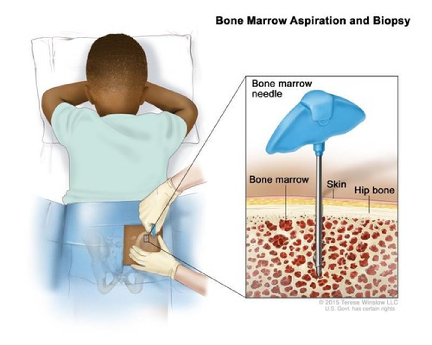 <p>To replace diseased bone marrow after high-dose chemotherapy/radiation.</p>
