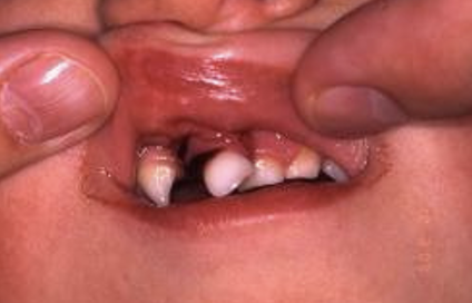 <p>what types of periodontal tissue injury is this</p>