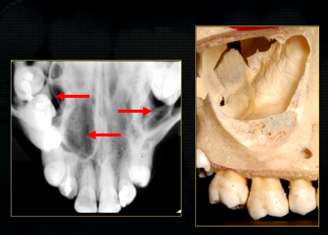 <p>density of the maxillary sinus varies </p>