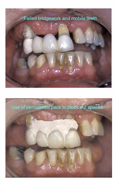 <ul><li><p>Blocking out tooth undercuts - prior to impression taking</p></li><li><p>a digital scan can be used to record the shape o the teeth and supporting tissues where teeth are very mobile&nbsp;</p></li></ul><p></p>