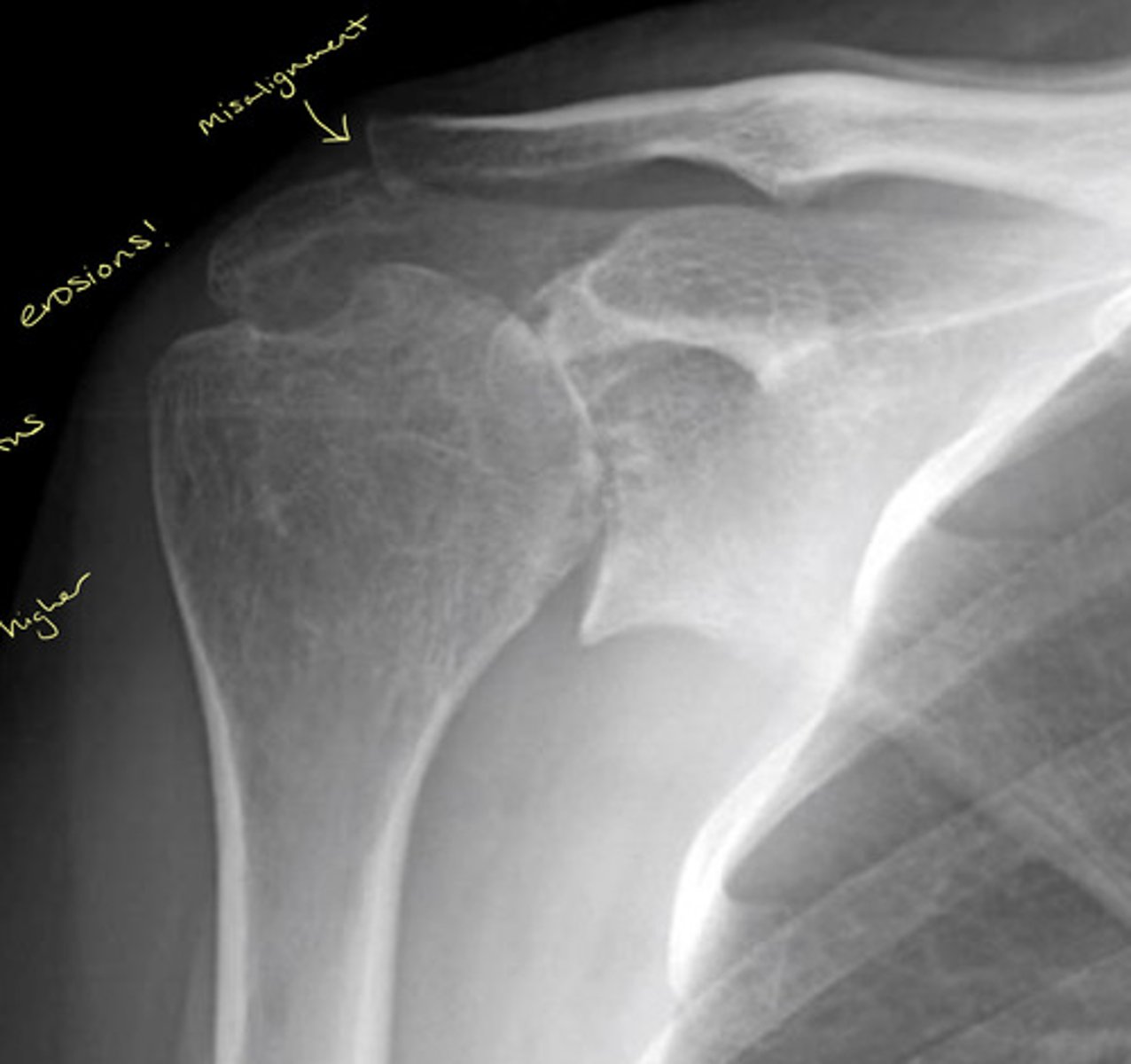 <p>Erosions, misalignment, and the humerus head is higher (most likely due to supraspinatus tendon erosion)</p>