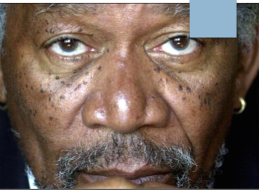 <p>what kind of lesion are these </p>