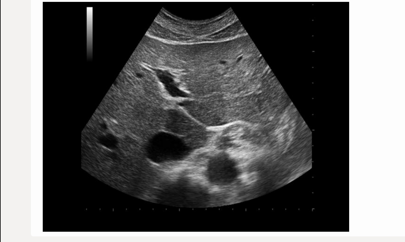 <p>[IVC is posterior to caudate lobe]</p>