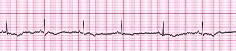 <p><span>The&nbsp;_______&nbsp;arrhythmia is characterized by no palpable pulse or electrical activity. Compressions are required for this arrhythmia. Please name the arrhythmia shown below.&nbsp;</span></p>